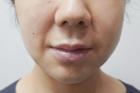 干细胞皮肤注射