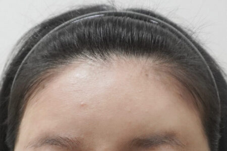 额头玻尿酸（BebeFill）