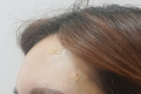 额头玻尿酸 (BebeFill)