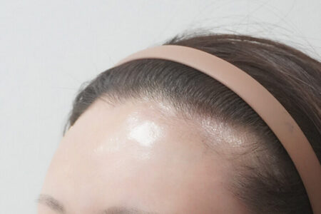 额头玻尿酸 (BebeFill)