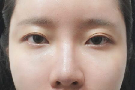 太阳穴填充 + 高鼻玻尿酸