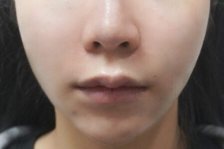 中庭缩小提拉 + 法令纹玻尿酸